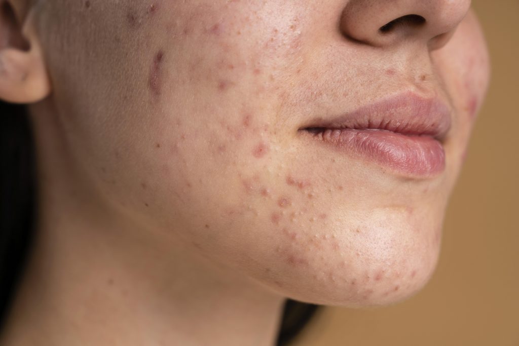 Acne Treatment